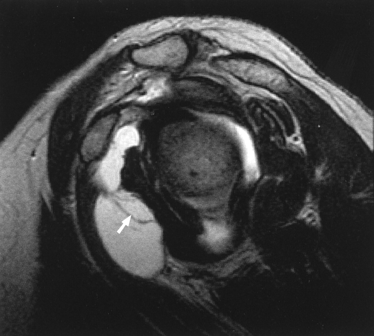 Rheumatology's tweet photo. If we see a subcoracoid bursa, we must differentiate sonographically or exceptionally on MRI between a real isolated subcoracoid bursa, a subcoracoid extension of the subdeltoid bursa, a coracobrachial bursa and a subcoracoid extension of the recess under the subscapularis (anatomically correct, this does not actually correspond to a bursa, as up to 98% of it communicates with the joint).

https://t.co/msQ3frOdET

https://t.co/rfC7tIsV4z