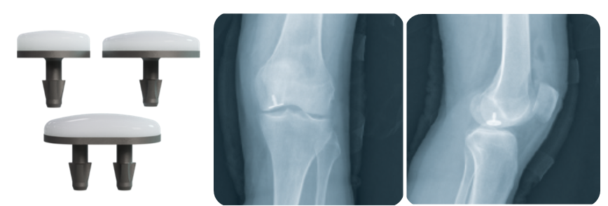 BioPolyOrtho's tweet photo. 📢 The BioPoly Knee System is coming to America! 📢

We look forward to enrolling our first BioPoly Knee patient right here in our hometown of Fort Wayne, IN! 

See our 5-year published results here: https://t.co/1OnnkgnBMQ

#biopoly #knee #comingsoon #america #syntheticcartilage https://t.co/56L0bGTfYd