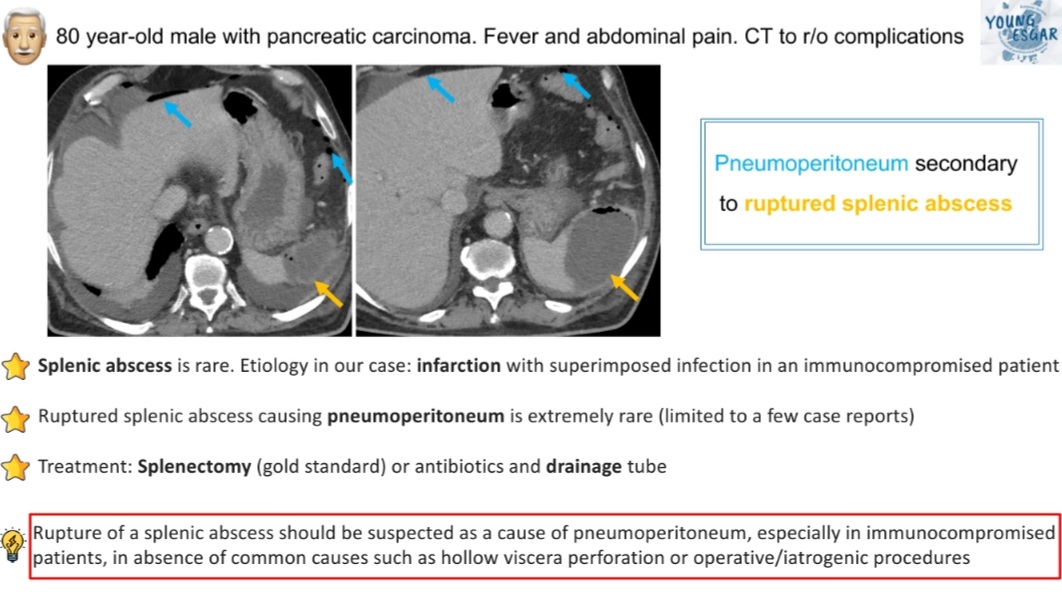 Extremely rare!! Have you ever seen this? Rupture of splenic abscess causing pneumoperitoneum 🤯 Learning points ⬇️ Further 📚 sciencedirect.com/science/articl…