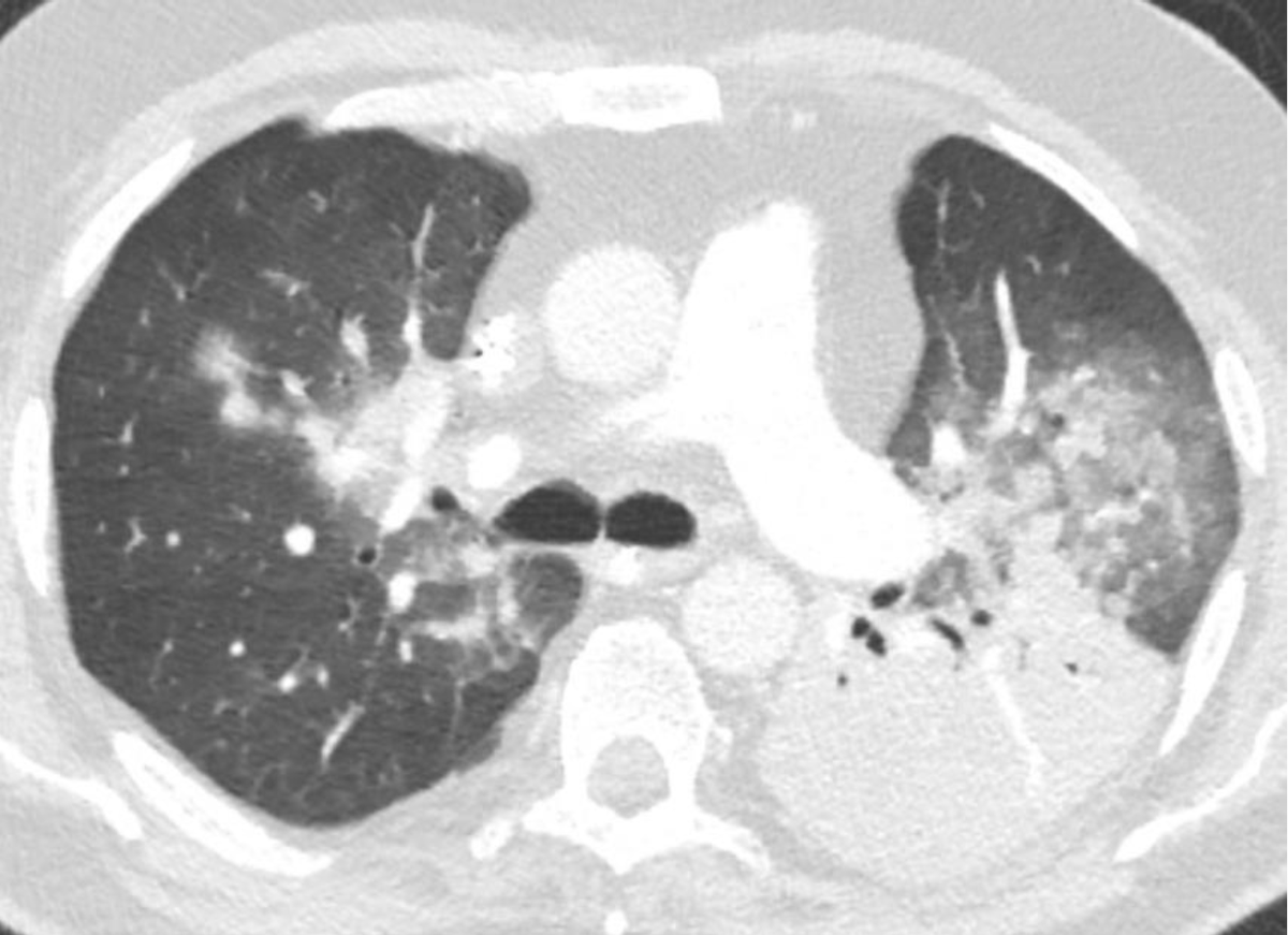 🤔 Tout ce que vous avez toujours voulu savoir sur la Pneumocystose pulmonaire du patient immunodéprimé, VIH ou non-VIH, sans oser le demander. 🫁 🔗 Voir l'article 👉 : zurl.co/OzRB #RevueMIR #SRLF