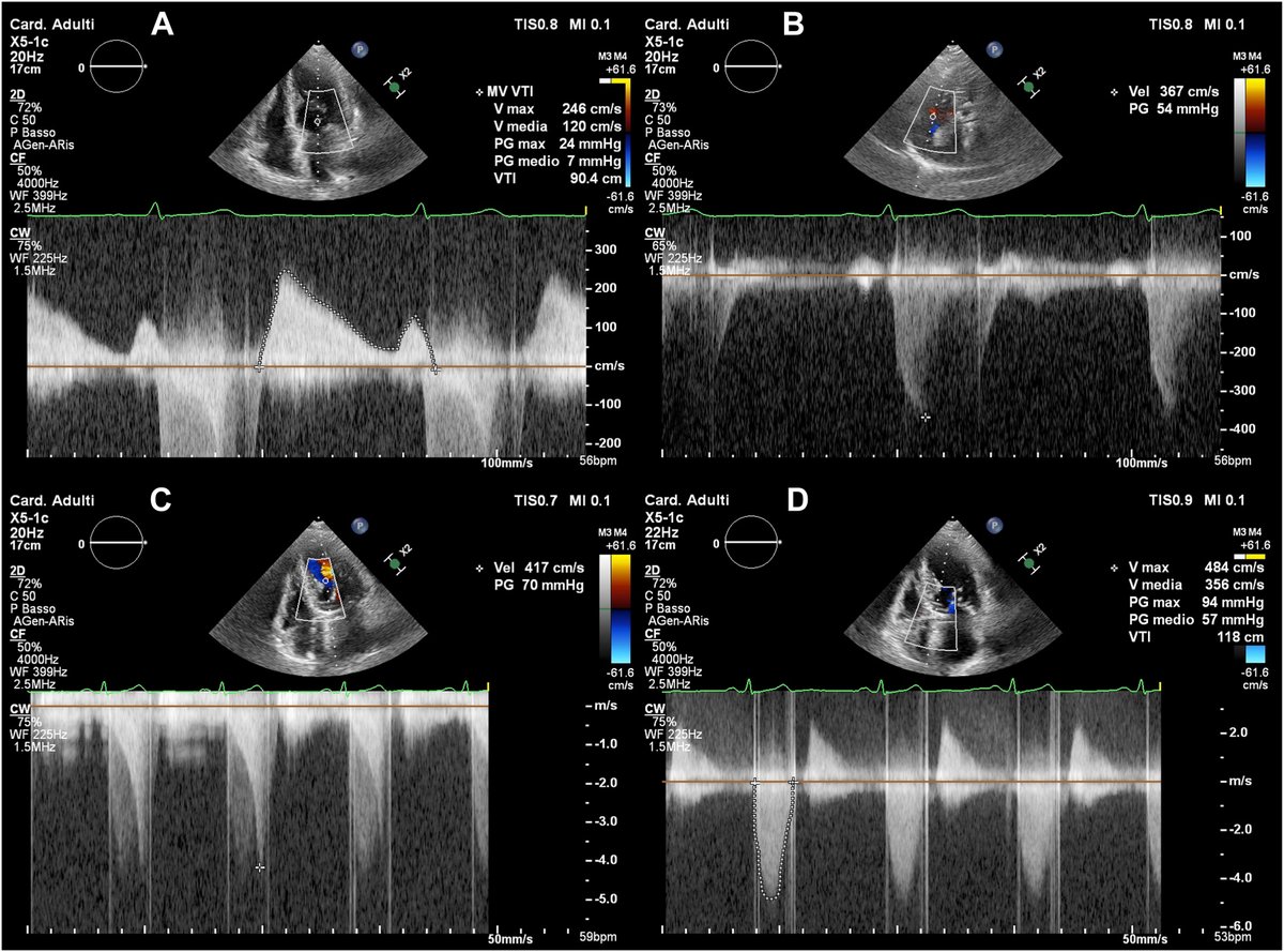 Mitral arcade (MA) is an uncommon congenital malformation of the tensor apparatus of the mitral valve (MV). This @CASEfromASE report features a patient with two bridges of fibrous tissue between the tips of the two papillary muscles consistent with MA. bit.ly/497NdCc