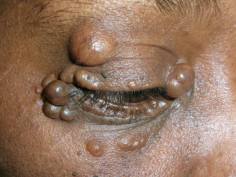 Gazal6849's tweet photo. @IhabFathiSulima 🍁A #Hidrocystoma is a benign cystic tumor that grows slowly & usually appears on the scalp or face,especially the eyelid👁️🗨️
📝It is also known as a cystadenoma,sudoriferous cyst,or #Moll's gland cyst.
📝Hidrocystomas are derived from either the #apocrine or sweat gland💅 https://t.co/xZhHxzPNtA