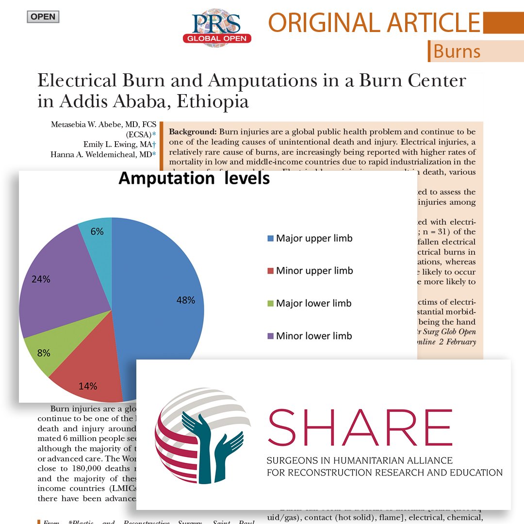 Read this new article, 'Electrical Burn and Amputations in a Burn Center in Addis Ababa, Ethiopia,' which is highlighted as part of #PRSGlobalOpen's partnership with the PSF's SHARE program: bit.ly/EthiopaBurnCen…