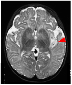 1/ We're seeking enthusiastic students &amp; post-docs to join <a href="/ShenYingZhang1/">Shen-Ying Zhang</a>'s team in hgid.org to explore the human genetic and immunological basis of viral encephalitis, in a global cohort of patients with encephalitis due to herpesviruses, arboviruses and others.