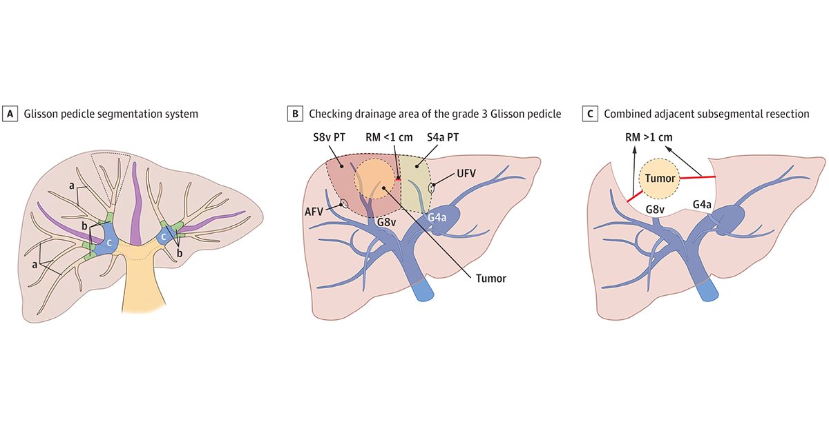 Most viewed in the last 7 days from <a href="/JAMASurgery/">JAMA Surgery</a>: 

Surgical Innovation article describes the use of anatomic resection of the liver based on portal territory with margin priority for the treatment of hepatocellular carcinoma.

ja.ma/43supwe