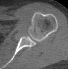 22-year-old basketball player has recurrent instability despite #labral repair two years ago. What is happening here, and how would you manage him now?

#LearnwithAAOS online learning programs and self-assessment and earn #CME and #SAE for #MOC bit.ly/2IIlLV7
#orthopedic