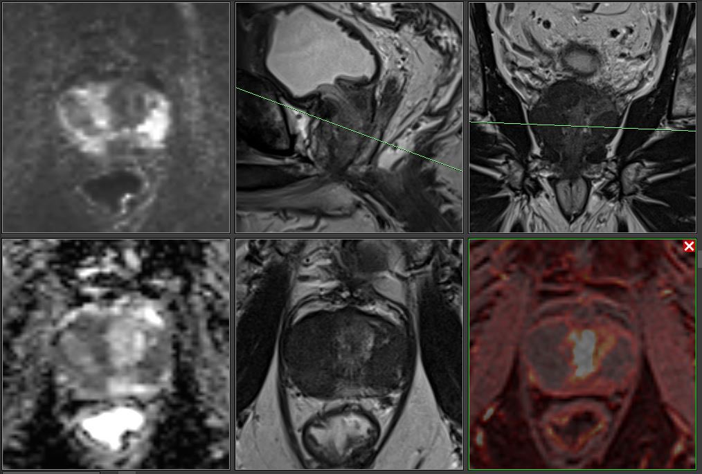 Another wonderful case for our Advanced prostate MRI course at MMCI @MOU_Brno Hint: Read the patient summary.