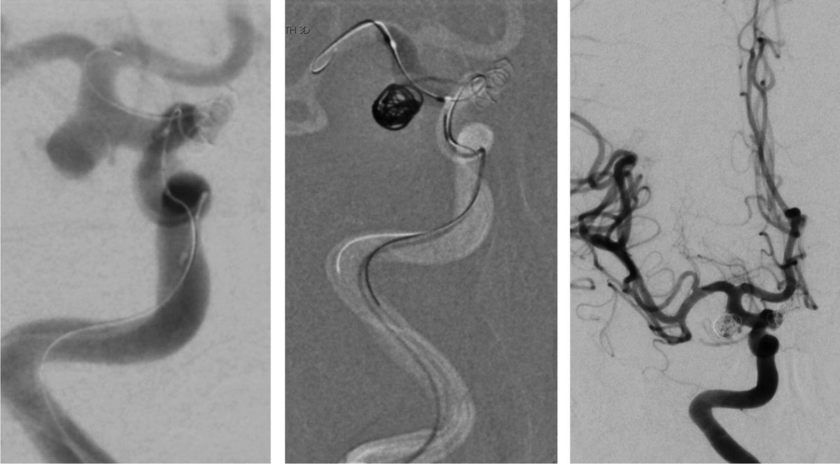 SundeepManglaMD's tweet photo. Multiple Aneurysms are often observed in SAH patients. Often, it is difficult to determine which aneurysm has ruptured and is most Urgent to Treat. In these Cases, treatment of Multiple Brain Aneurysms at 1 time is occasionally required, and should be strongly considered! https://t.co/gBKcInraPt