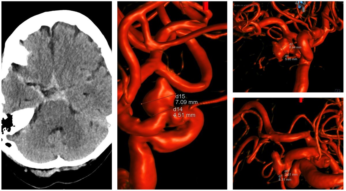 SundeepManglaMD's tweet photo. Multiple Aneurysms are often observed in SAH patients. Often, it is difficult to determine which aneurysm has ruptured and is most Urgent to Treat. In these Cases, treatment of Multiple Brain Aneurysms at 1 time is occasionally required, and should be strongly considered! https://t.co/gBKcInraPt