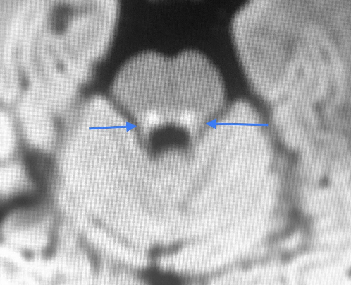 One of those  “gray” findings in #NeuroRad 
🔵Central tegmental tract hyperintensity (CTTH) could be interpreted as a normal neurodevelopmental aspect or associated with different neurological issues. 
Depending on the context the relevance is diferent. Keep yourself updated.