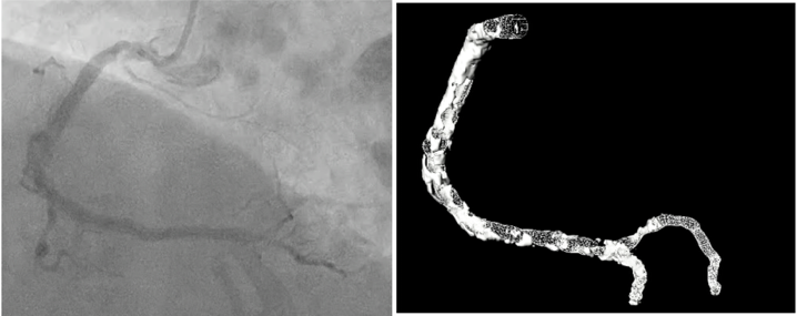 It is just remarkable to see how much CT complements angiography and significantly enhances PCI When it comes to calcium assessment, it's a complete game changer! @jcspratt @ziadalinyc @jeroen_sonck @ESHLOF @djc795 @DrAllenJ @DrNataliaP @fredericbouisse