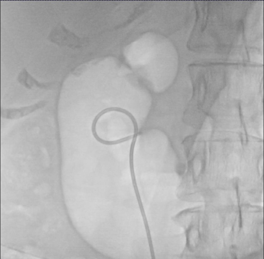 Primary RIRS-FANS for Large Right Renal Calculi Unedited video. youtu.be/xzk1mo2oqIU Key Highlights 🔹35 minutes Sheath Indwelling time in ureter 🔹Stone dusting till very end with TFL with intermittent use of continuous suction mechanism by side of scope with FANS 🔹Stone