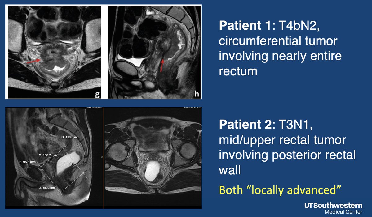 Thank you @ACRORadOnc and @OncLive! Just to elaborate on this. One of the points of my talk was that to optimize QOL, we have to appreciate there is much heterogeneity in locally advanced rectal cancer. In this slide I presented below, both patients would be classified as LARC,