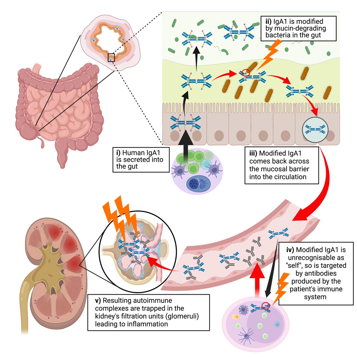 We show the gut microbiota directly generates auto-antigens by modifying glycosylation of a human glycoprotein (IgA1) in an autoimmune disease called IgA nephropathy. Published @ScienceTM bit.ly/4cw3gwD @DrBenechNicolas @JMChemouny @h_sokol @Inserm @Pharmabiotic @APHP