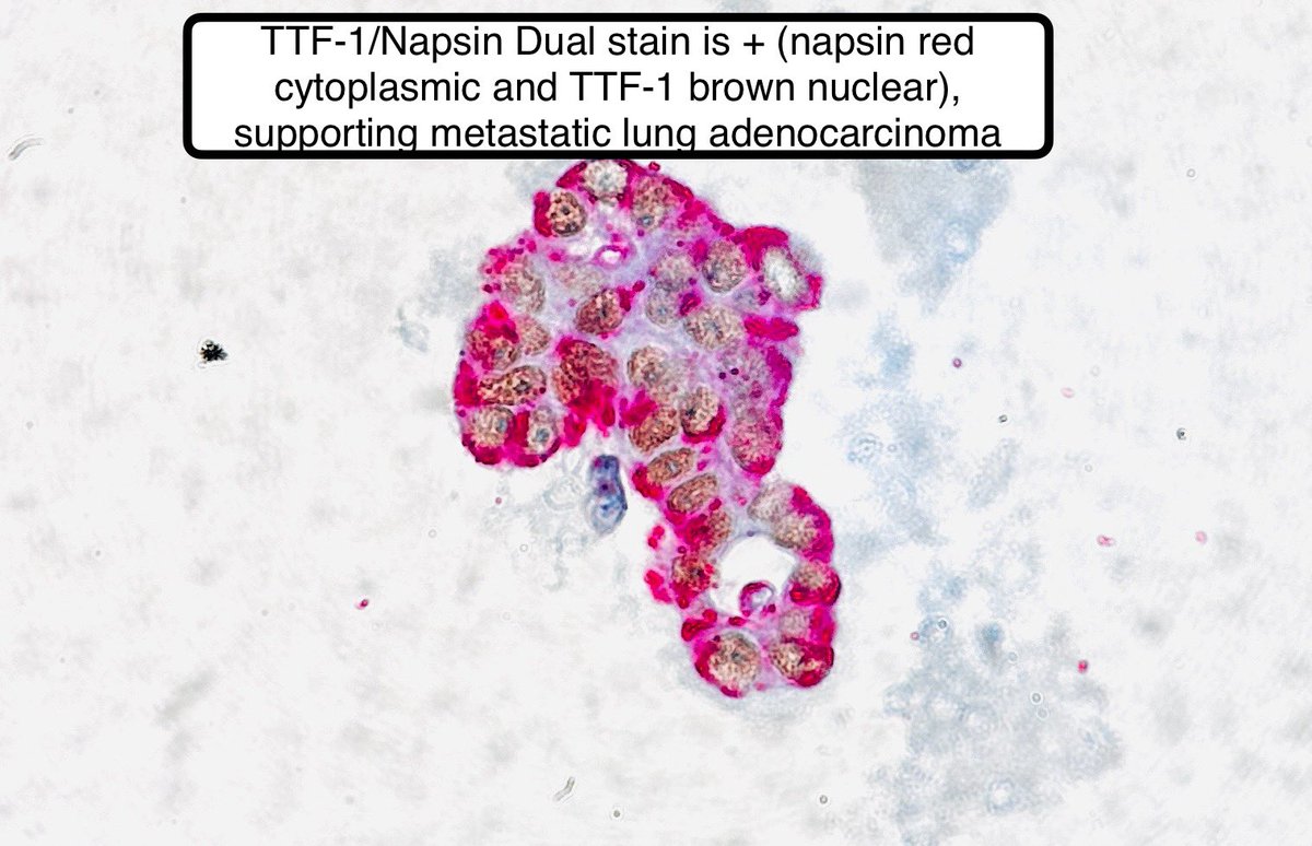 Cytology of Pleural Effusion in a Smoker

Teaching Points: 🙏🏼 to my Cytopath Staff

Dx: Metastatic Lung Adenocarcinoma 

#path4people #pathx #pathologyx #pathagonia #cytopath #cytology #hemeonc #pulmonology #ctsurgery #pulmx #medx #oncology #medicine #medstudentx #surgpathx