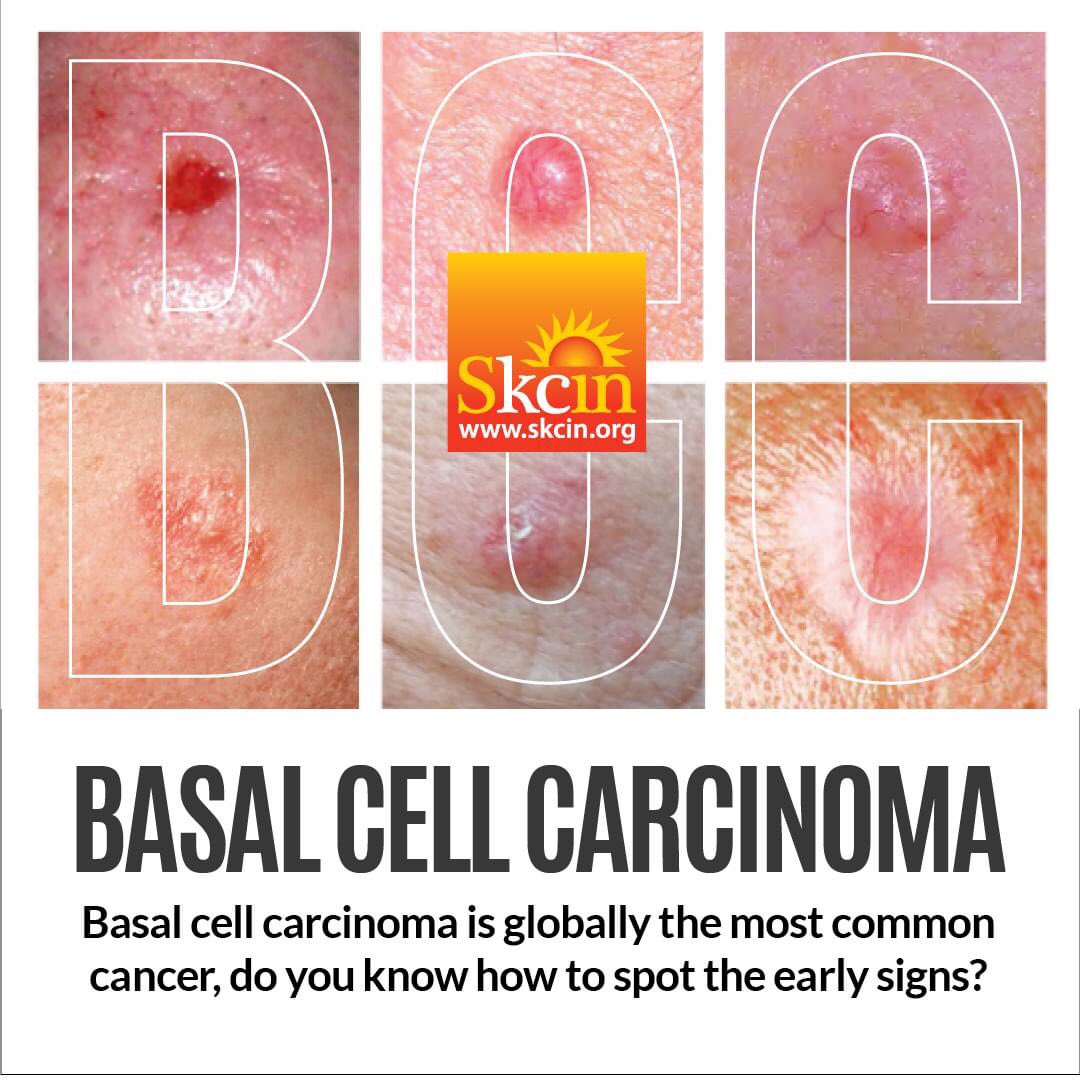 BCCs usually present on areas of skin most frequently exposed to UV radiation such as scalp, face, ears, neck & forearms.Large or neglected BCCs can cause extensive local invasion & disfigurement due to surgery so if you detect anything of this nature no matter how small see a GP