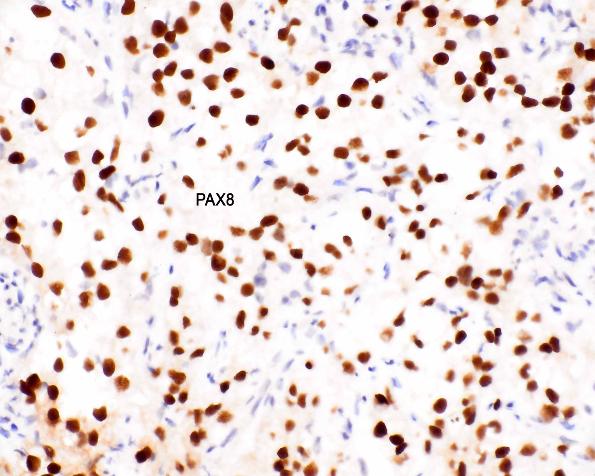 Spectacular case: clear cell renal carcinoma that has spread to para-esophageal tissue. #UMiamiPath