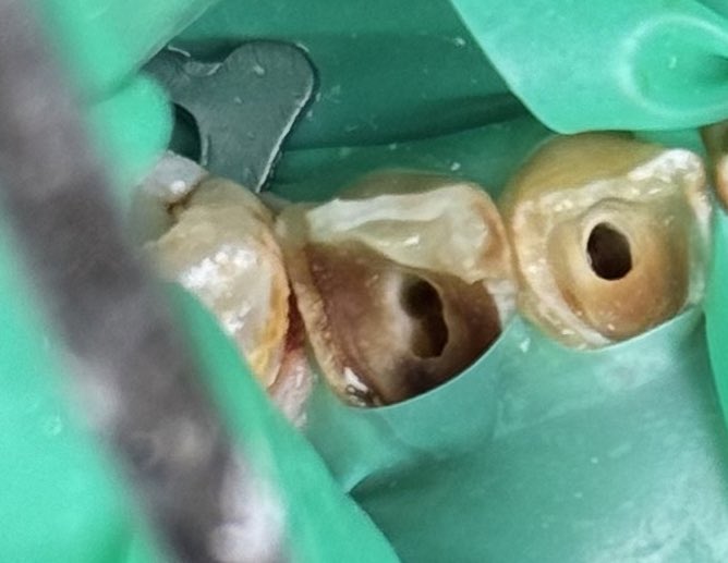 a7_qu1's tweet photo. Endo surprises 🦷
Lower canine and lateral with two canals 😵💫
#endodotics #dentistry https://t.co/J6qMImPvuu