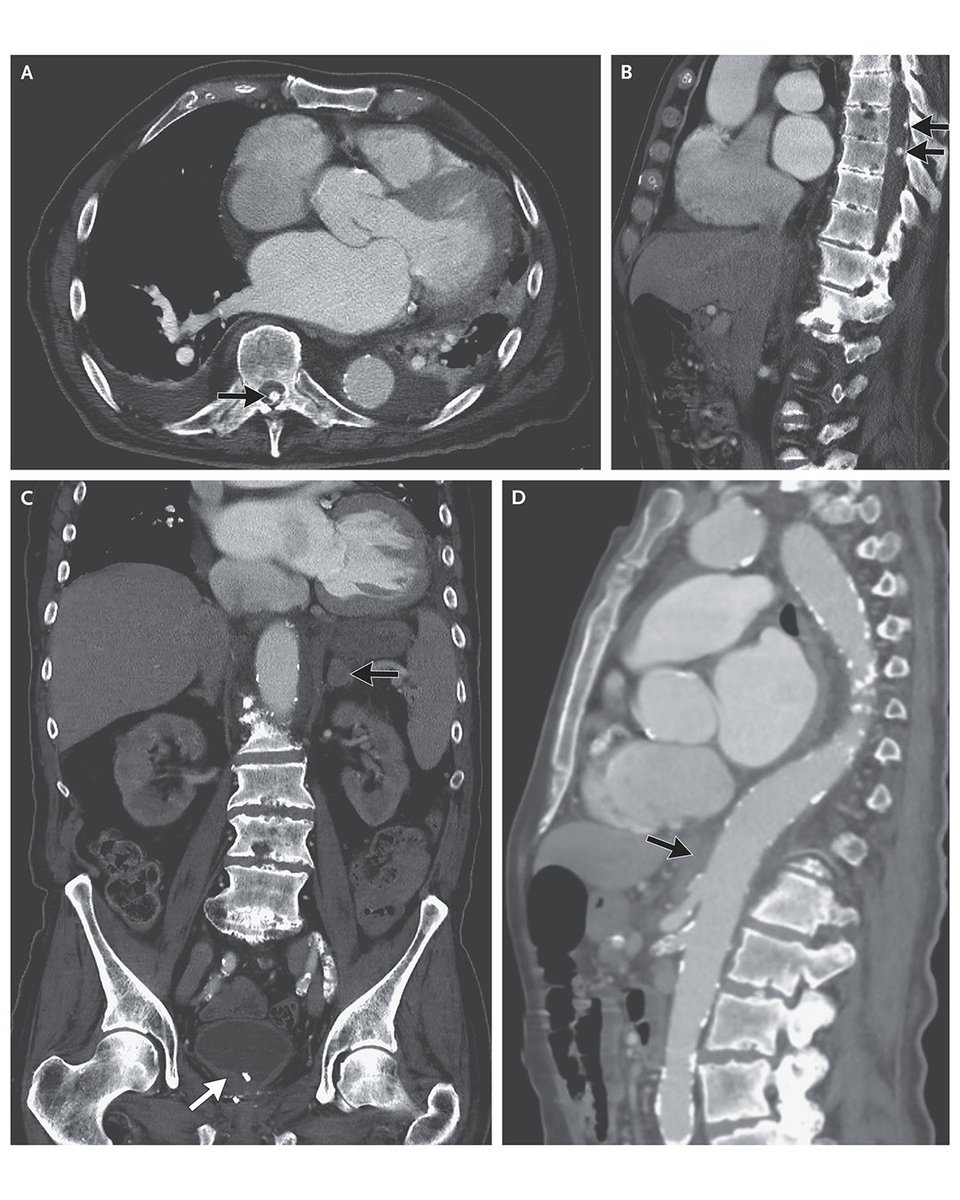 NEJM (@nejm) on Twitter photo In the latest Case Record of the MGH, an 84-year-old man was evaluated at the hospital for a fall and admitted for treatment of a presumed urinary tract infection. On hospital day 4, severe chest pain developed. A diagnosis was made. Read the full case: nej.md/3TtfI7F In the latest Case Record of the MGH, an 84-year-old man was evaluated at the hospital for a fall and admitted for treatment of a presumed urinary tract infection. On hospital day 4, severe chest pain developed. A diagnosis was made. Read the full case: nej.md/3TtfI7F