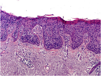 Historical, clinical, histological and molecular evidence to show that the terms ‘Bowen disease’ and ‘intraepidermal squamous cell carcinoma’ should not be used synonymously. rcpa.me/PathJournalWood #Pathology #PathTwitter #MedTwitter #MedEd #PathResidents
