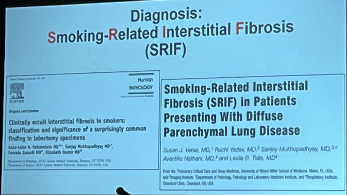 Educational & Entertaining learning from Dr Sanjay Mukhopadhyay @smlungpathguy on SRIF=smoking related interstitial fibrosis at #pulmpath Evening Specialty Conference #USCAP2024