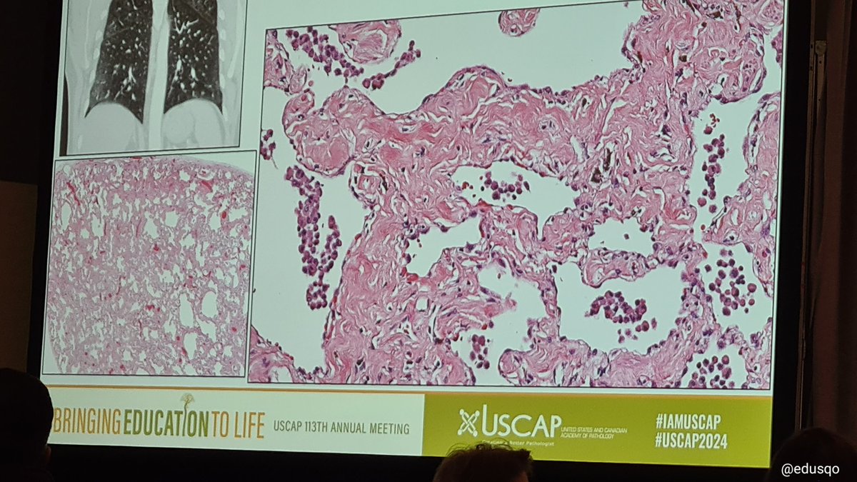 Dr Sanjay Mukhopadhyay @smlungpathguy at #USCAP2024 #PulmPath Evening Specialty Conference. Smoking-Related Interstitial Fibrosis #SRIF #StopTobacco