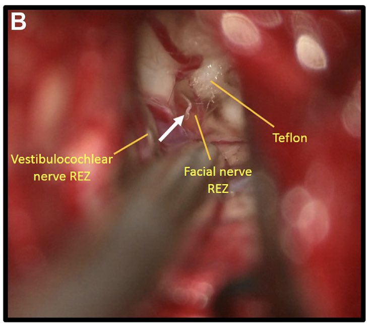 Mehdi Khaleghi MD (@mehdikhaleghii) on Twitter photo Typical symps of #geniculate_neuralgia + medically refractory + visible neurovascular
conflict = Go ahead and cut it in the middle,
even the small one! Thanks to
<a href="/PrevedelloDanny/">Danny Prevedello</a> for doing this exciting operation.
<a href="/OSUWexMed/">The Ohio State University Wexner Medical Center</a>
<a href="/NeurosurgeryOSU/">Ohio State Neurosurgery Residency</a>
<a href="/WorldNeurosurg/">World Neurosurgery Journal</a> Typical symps of #geniculate_neuralgia + medically refractory + visible neurovascular
conflict = Go ahead and cut it in the middle,
even the small one! Thanks to
<a href="/PrevedelloDanny/">Danny Prevedello</a> for doing this exciting operation.
<a href="/OSUWexMed/">The Ohio State University Wexner Medical Center</a>
<a href="/NeurosurgeryOSU/">Ohio State Neurosurgery Residency</a>
<a href="/WorldNeurosurg/">World Neurosurgery Journal</a>