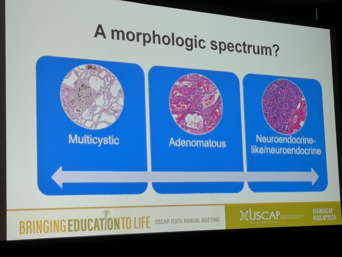 Dr. Christopher Przybycin @malignantwave on the impressive morphologic and IHC heterogeneity of chromophobe RCC #GUPath. Highly educational lecture @TheUSCAP #USCAP2024!