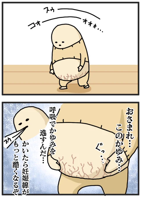 妊娠線はいつ消えるんや?(産後2年) 
