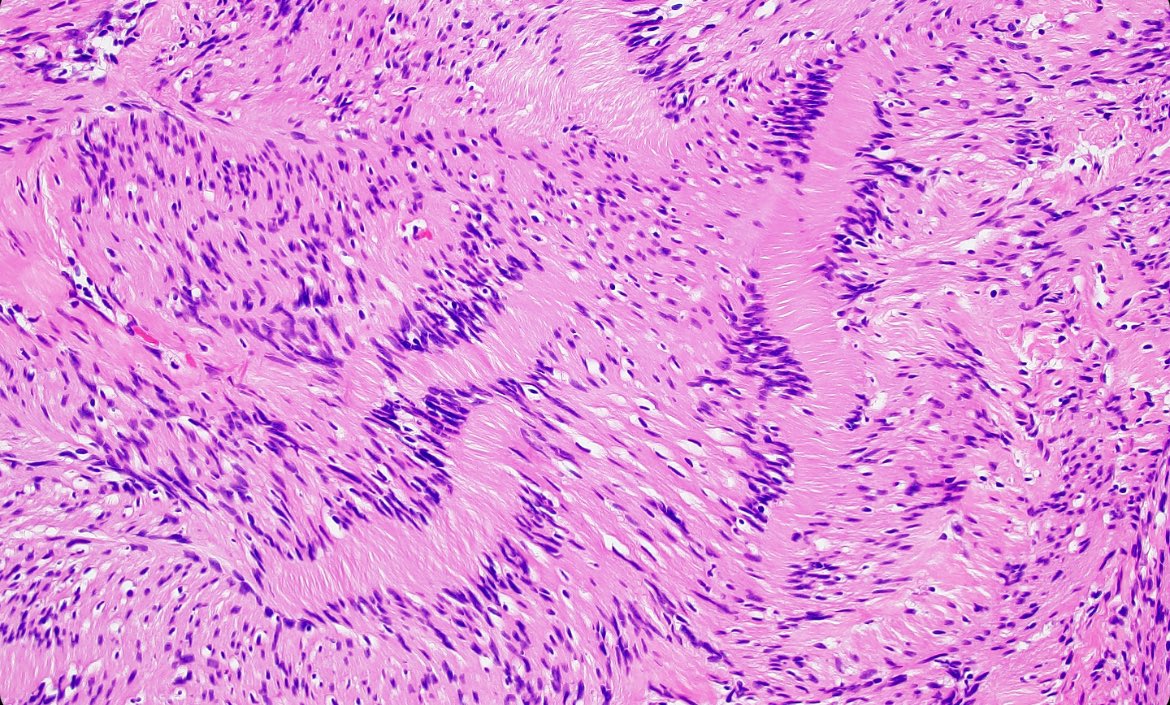 Paraspinal tumor. Diagnosis? What distinguishing feature is shown in this #PathClassic? #neuropath #PathTwitter #PathX 🧠🔬