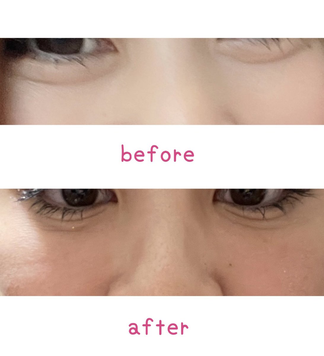 tetotetora111's tweet image. 脂肪再配置(裏ハムラ)+脂肪注入、まじで大失敗されたんですけど。笑った時地獄みたいな線が生まれる。凹みクマで、若返りたくてやったのにさらに老けた。1枚目元の笑顔、2枚目が術後の笑顔。韓国の有名な病院だよーーー😭