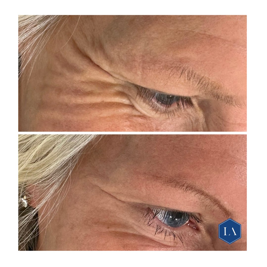 Anti-wrinkle injections addressing crow's feet. These injections effectively minimize the appearance of smile lines at the side of the eyes.

#BeforeAndAfter #antiwrinkletreatments #crowsfeet #essex #kent #london
#medicalprofessionals  #luxtonaesthetics #essexclinics #kentclinics