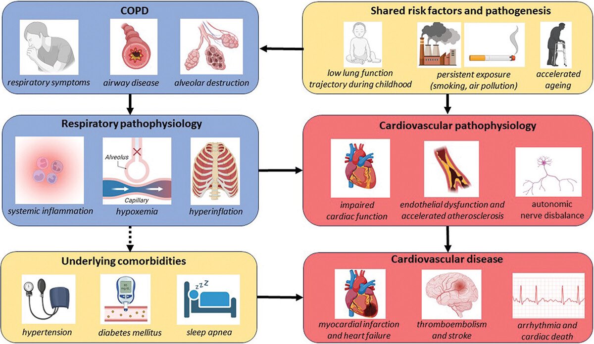 Our state-of-the-art open access review on cardiovascular disease and risk in COPD is now on line… tandfonline.com/doi/full/10.10…