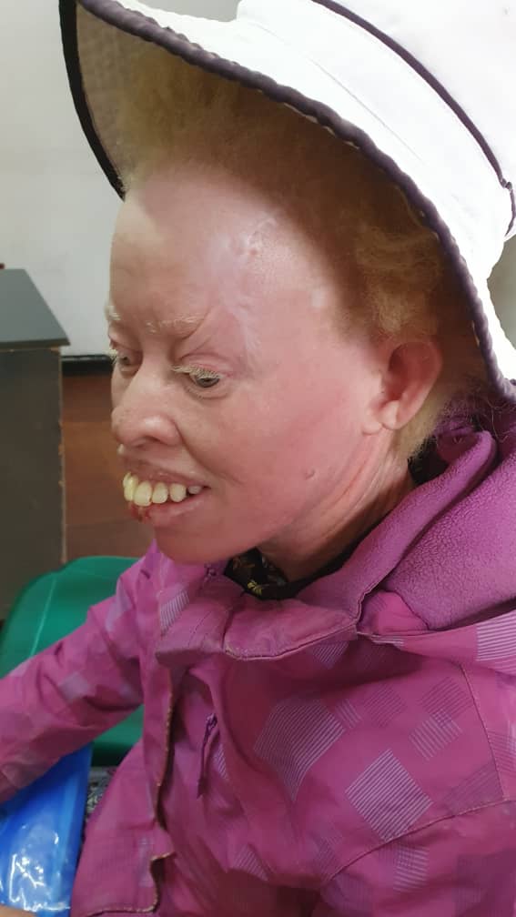 Join the fight against skin cancer by support the Albinism Konnect Skin Cancer Fund , donate any amount towards the cause. Did you know from 2020 together here on X we have impacted over 4000 lives of people with albinism in Zimbabwe, lets keep on the fight together we can Repost