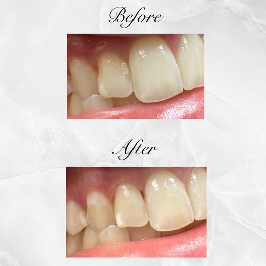promenadecenter's tweet photo. This patient presented with a broken filling, which Dr. Alina repaired seamlessly 📷 We love seeing everyone leave our office with a confident smile!
#promenadecenterfordentistry #brokenfilling #teeth #dentaloffice #clt #cltdentist #dentistry #orthodontics #oralhealth https://t.co/ycBVHmcven