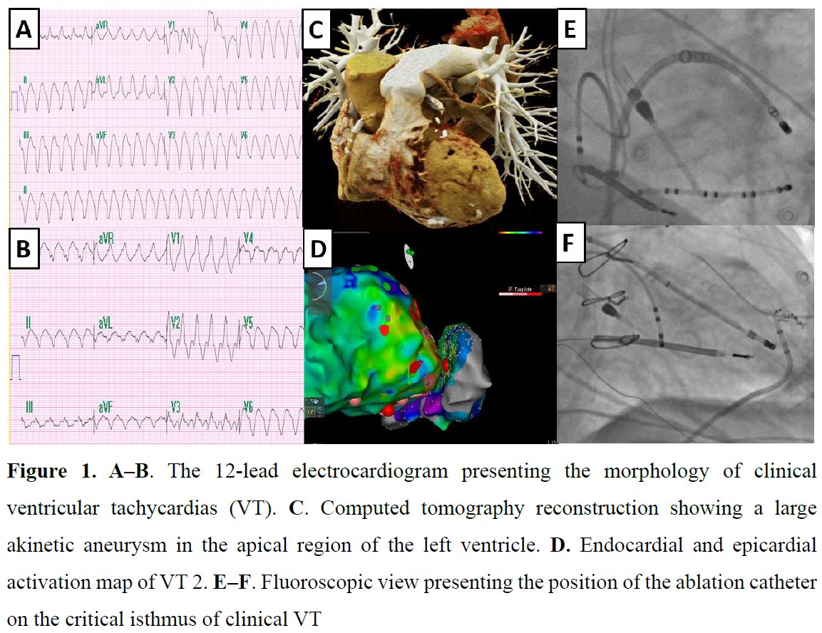 Editors' Insights: Epicardial #ablation of hemodynamically unstable VT supported by percutaneous assist device limited by LV #aneurysm and adhesions after #CABG. tiny.pl/dtb1v #PolishHeartJournal #CardioTwitter #HeartNews #Cardiology #CardioEd @HawranekMichal @livio81