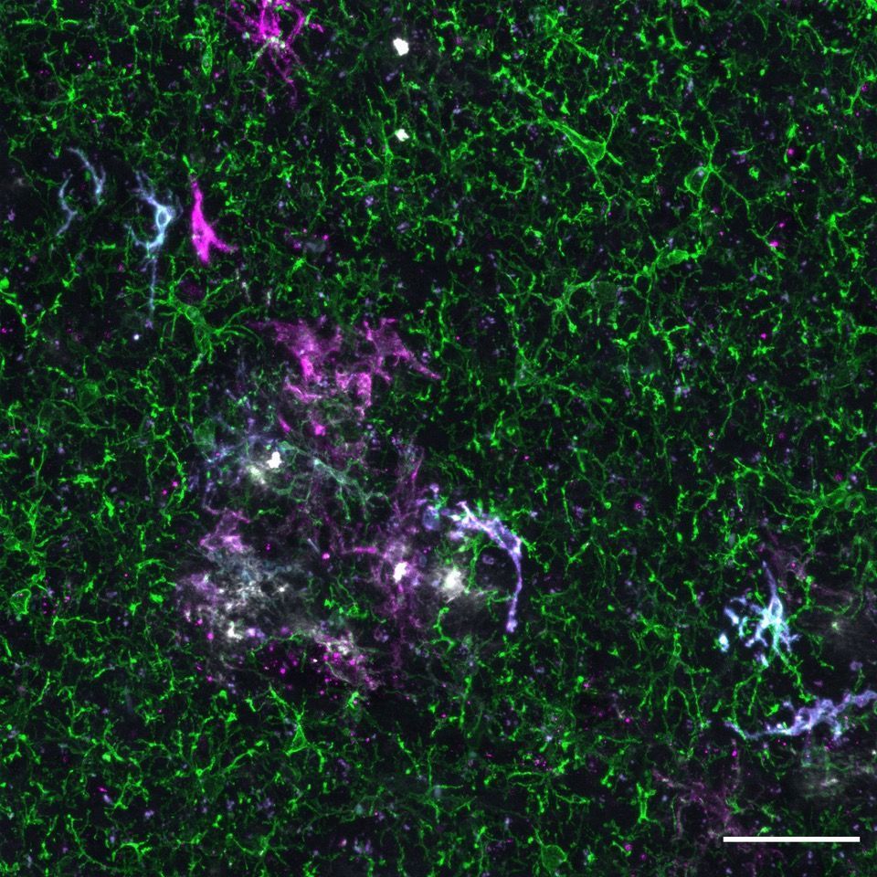 A team led by Prof Bart De Strooper (UK DRI at UCL & @CBD_VIB) has transplanted human microglia into mouse brains to study how the cells respond to amyloid plaques in #Alzheimers🧠 The findings could have implications for future treatments👉buff.ly/3TT7BCI