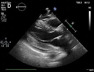 Delayed Pericardial Effusion Following Left Atrial Appendage Closure Mogalapalli; Kumar; Lobo; Reed; Palma Dallan; Yoon; Filby okt.to/R4WQ3J @InvasiveCardiol #cardiotwitter @HarringtonHVI