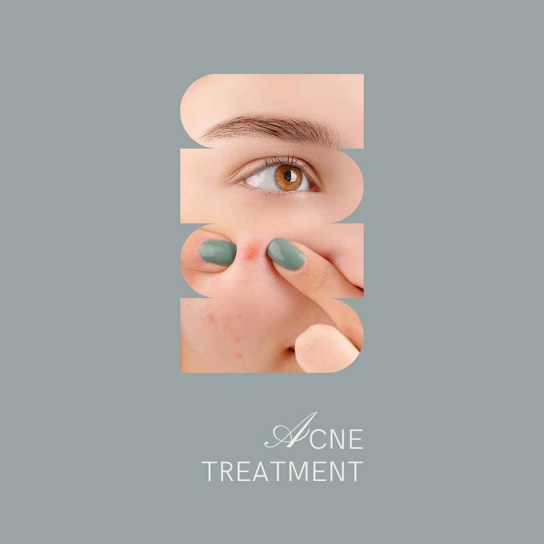 Effective acne treatment steps include:
1. Daily skin cleansing
2. Use noncomedogenic products to avoid clogged pores
3. Exfoliate regularly to remove dead skin
4. Apply topical treatments like benzoyl peroxide
5. Maintain a healthy diet and hydration

#skincare #acnetips