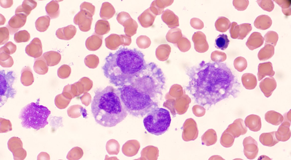 Kclarke864's tweet photo. Morphology guys… any suggestions? BM aspirate on patient with Hx of DLBCL. Mild pancytopenia, no evidence of clonal B-population by flow cytometry #haempath #morphology #haematology https://t.co/Rf0s3Xwqjo