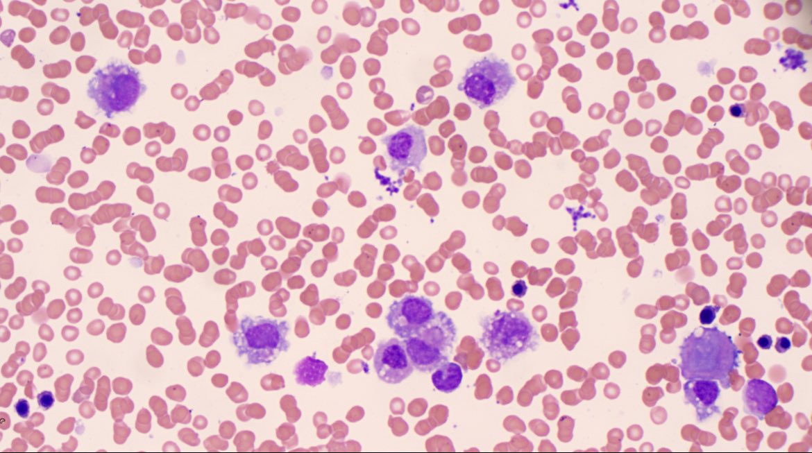 Morphology guys… any suggestions? BM aspirate on patient with Hx of DLBCL. Mild pancytopenia, no evidence of clonal B-population by flow cytometry #haempath #morphology #haematology