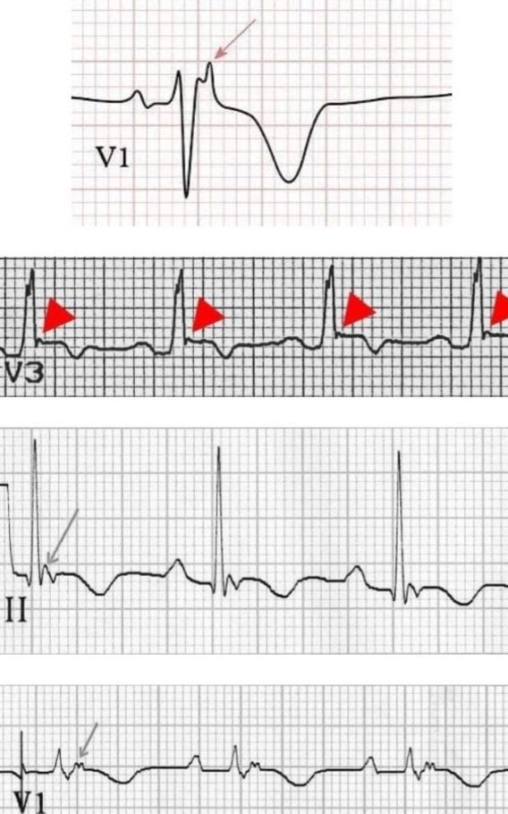 ECG spot Diagnosis. Case 4. 35yrs M presents with history of Palpitations and syncope. 1 Diagnosis? 2. Treatment?