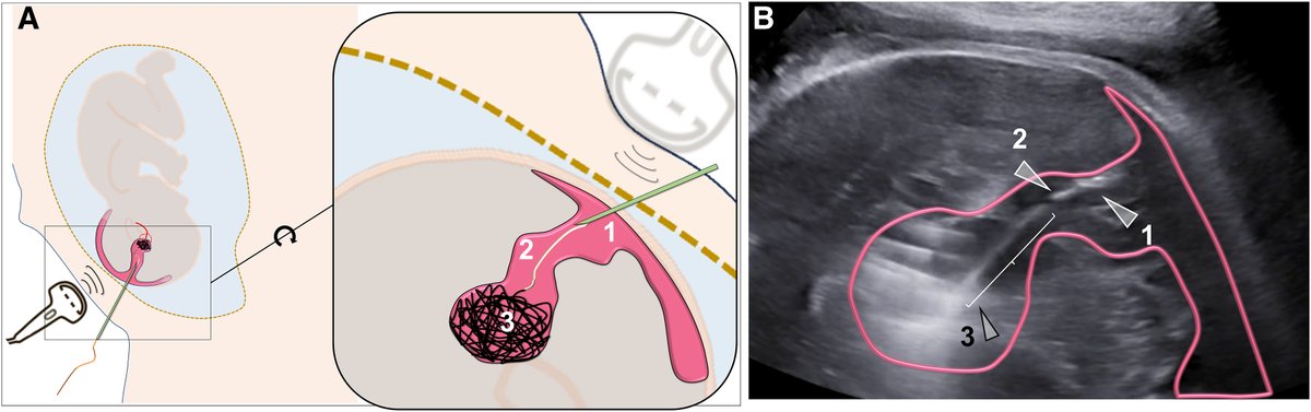 AJOG Images in Obstetrics: Prenatal treatment of a vein of Galen malformation by embolization and 1-year follow-up - Illustration of the technique with a patient with a vein of Galen malformation ow.ly/UXeG50R3Y0B