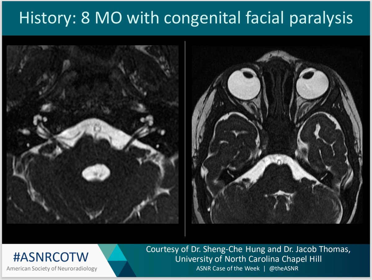 ASNR COTW #189 Hx: 8 MO with congenital facial paralysis NO SPOILERS! Give hints in the form of Gifs or answer attached poll. Answer in 24 hours. #neuro #neurorad #erad #radres #FOAMed #FOAMrad #medtwitter #ASNRCOTW