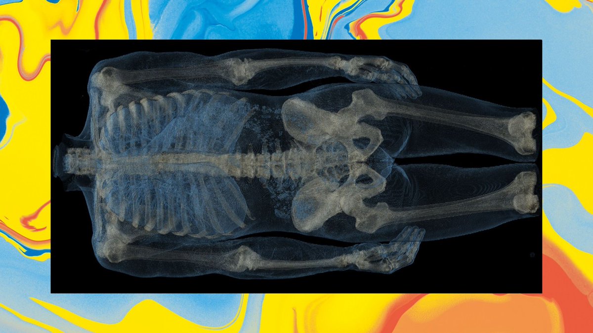 Heute ab 17:45 Uhr widmen sich die Expertinnen und Experten bei #RÖKODIGITAL den Hot Topics der forensischen Radiologie sowie der MRT in der forensischen Bildgebung: roentgenkongress.de/roeko-digital/… #RÖKO2024 #Radiologie #Fortbildung #forensischeRadiologie