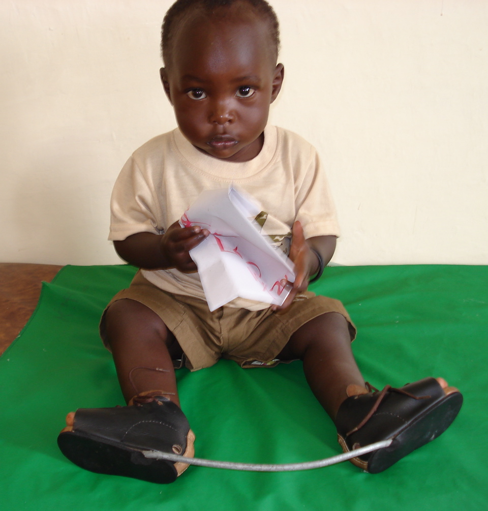 Assistive technology can transform lives. Yet, not everyone who needs it has access. We are proud to support #UnlockTheEveryday to improve access to Assistive Technology, such as clubfoot braces, for everyone. #ClubfootAwareness