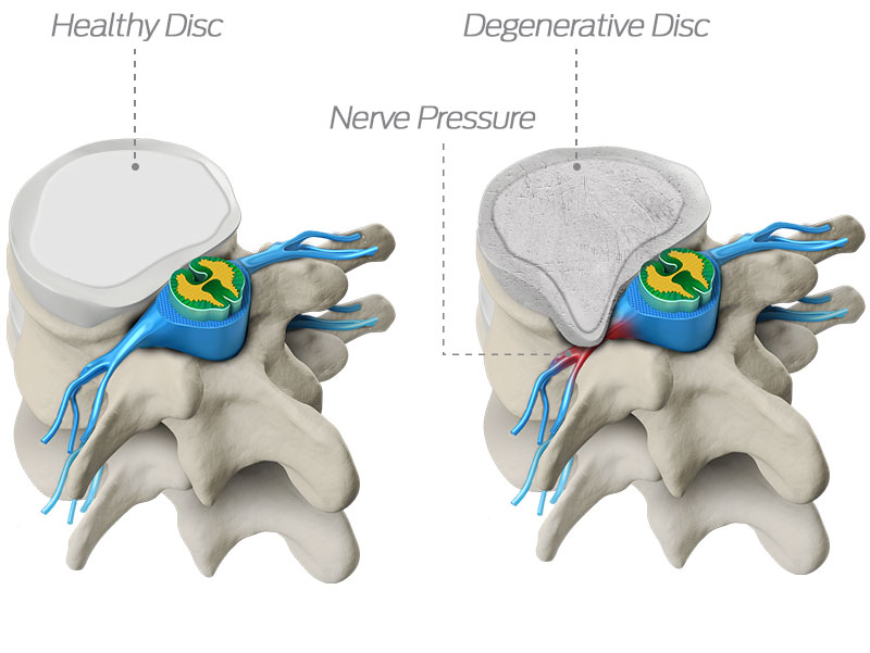 rediscovermylif's tweet image. As we age, our spinal discs degenerate, which may cause the disc to lose its height or bulge out—potentially compressing a nerve, causing pain or other symptoms. Learn more about spinal discs at rediscovermylife.org/anatomy.php.
#rediscover #centinelspine #spinaldisc #discbulge