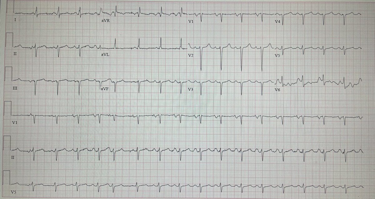 What lies beneath. Early 60’s F, worsening DOE, peripheral edema. #ECG #CardioTwitter #MedTwitter #MedEd #FOAMed