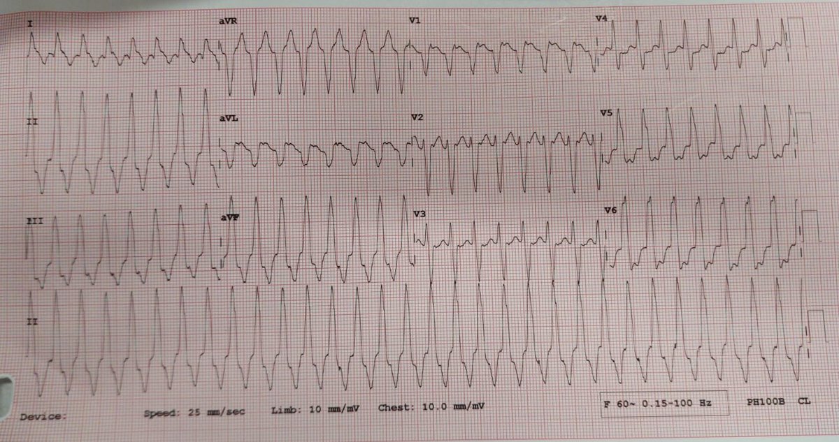 A 25-year-old male with a history of flu-like illness 15 days back, presented to ED with shortness of breath and palpitation for 4 hours.  What's the rhythm? @smithECGBlog @ECGWeekly @EcgsOnly @TA_ECG @ecgguru