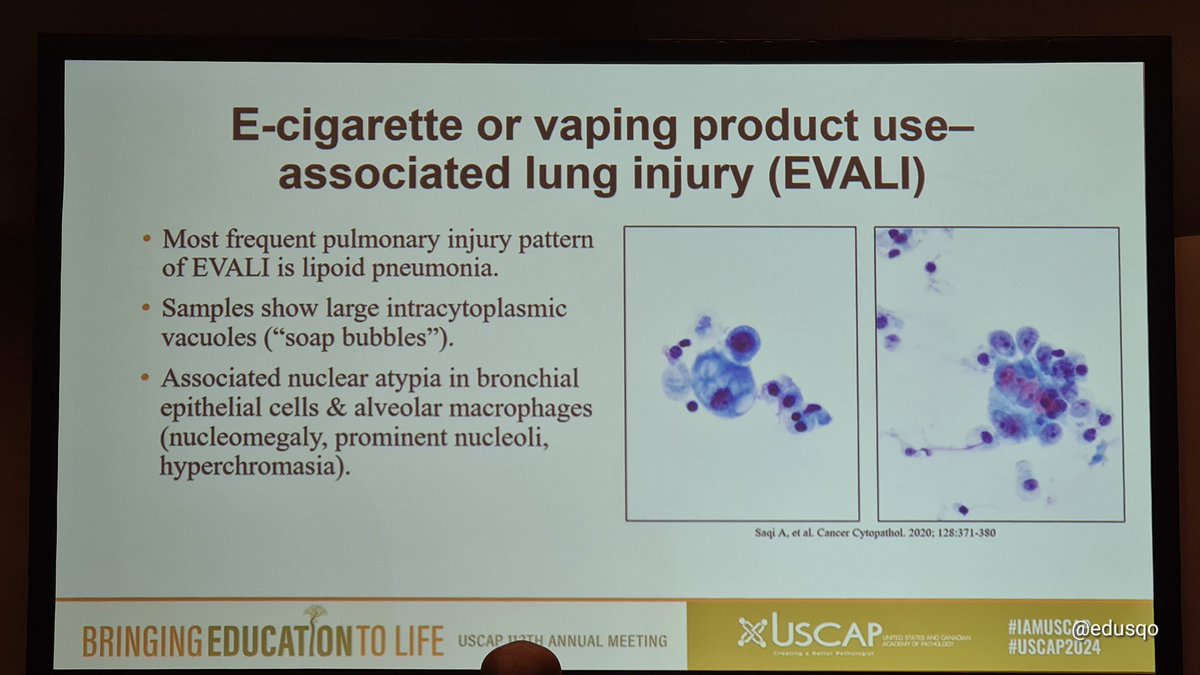 Dr. Liron Pantanowitz @PathPro talk at the Pulmonary Cytology Short Course #USCAP2024. Exogenous lipoid pneumonia: ▫️Exogenous causes: Inhalation or aspiration of mineral or vegetable oil, nasal sprays, e-cigarette or #vaping #EVALI or... lip gloss 👀. #CytoPath #PulmPath